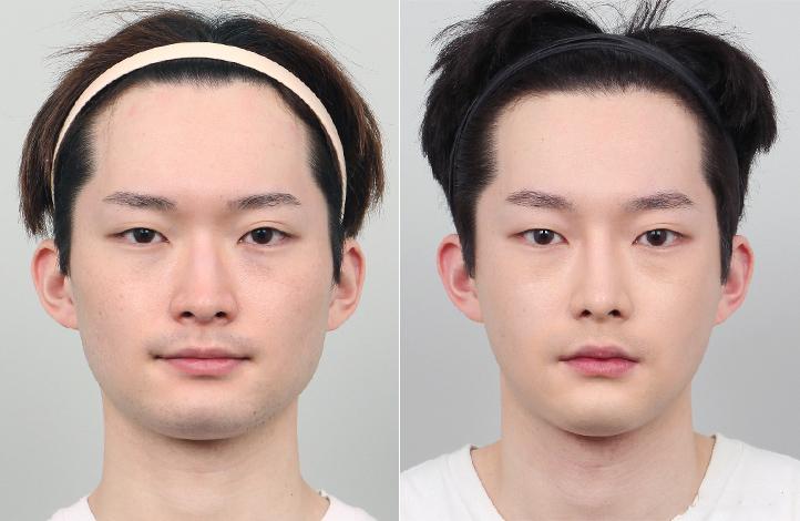 最新削骨技术及其步骤指南